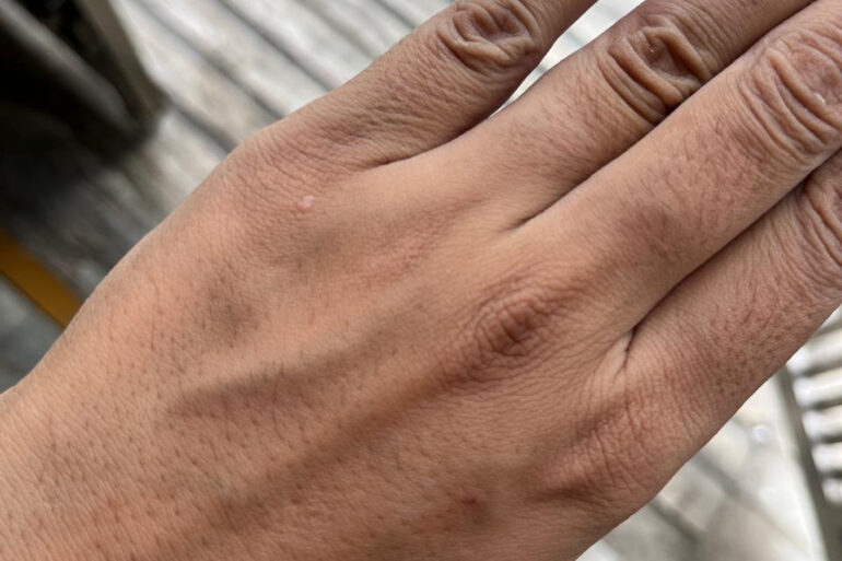 A young constable from Meerut, Uttar Pradesh, suffered from ugly flat warts got cured miraculously