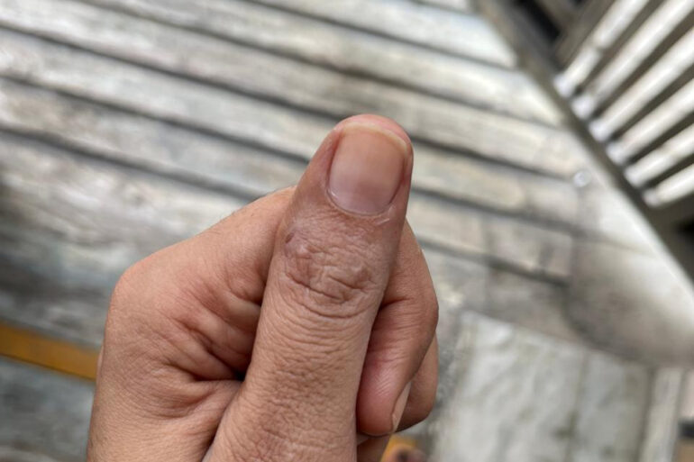 A young constable from Meerut, Uttar Pradesh, suffered from ugly flat warts got cured miraculously
