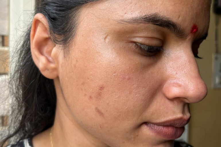 A young constable from Meerut, Uttar Pradesh, suffered from ugly flat warts got cured miraculously