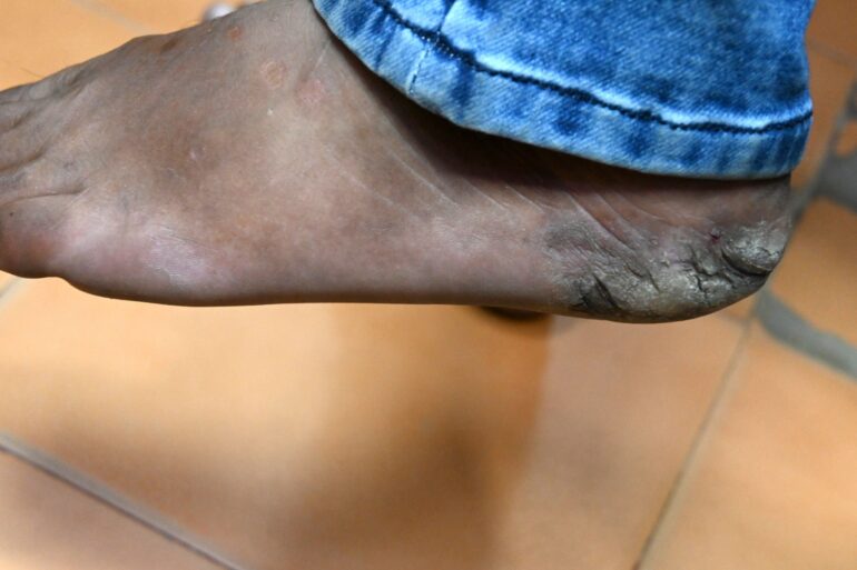 A case of Planter Psoriasis