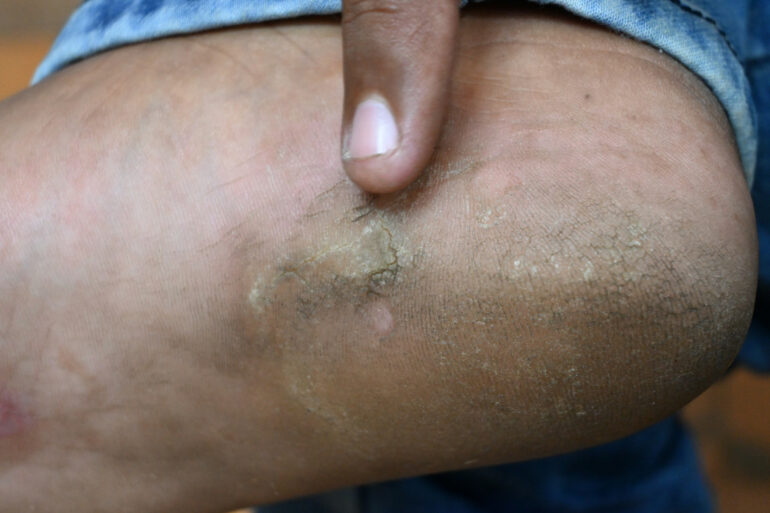 A case of Planter Psoriasis