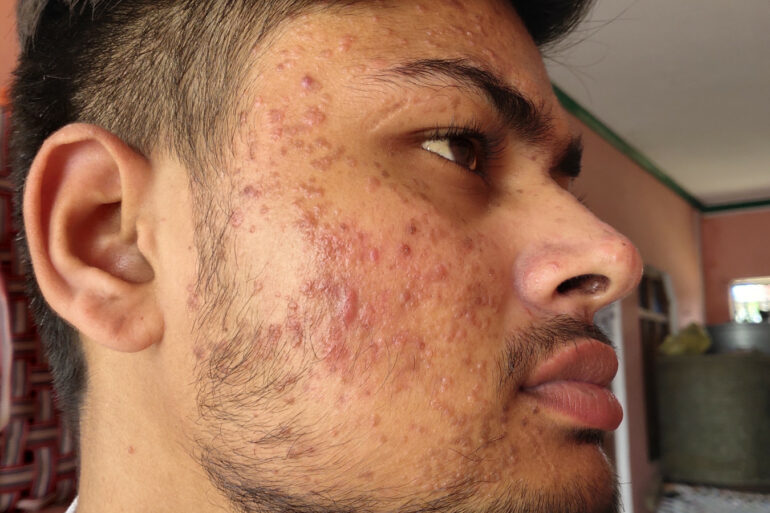 Flat warts for 7 years and Acne Vulgaris got cured in a patient from Ghaziabad