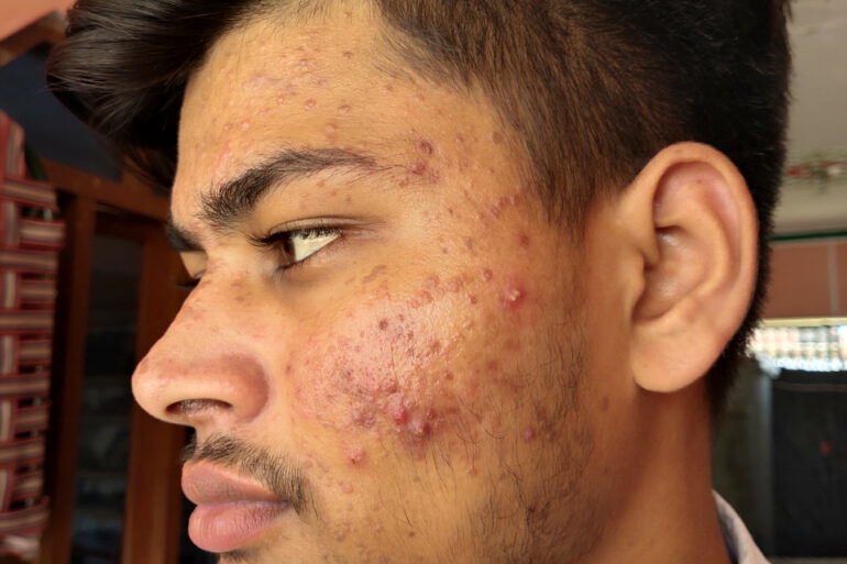 Flat warts for 7 years and Acne Vulgaris got cured in a patient from Ghaziabad
