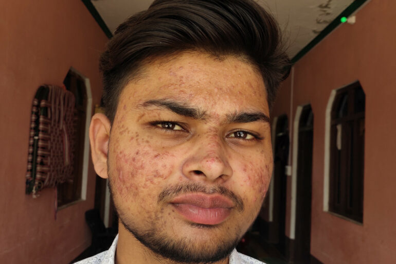 Flat warts for 7 years and Acne Vulgaris got cured in a patient from Ghaziabad