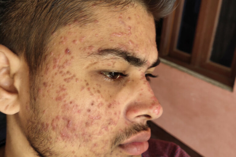 Flat warts for 7 years and Acne Vulgaris got cured in a patient from Ghaziabad