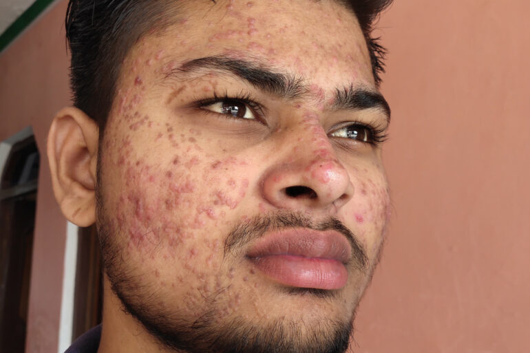 Flat warts for 7 years and Acne Vulgaris got cured in a patient from Ghaziabad