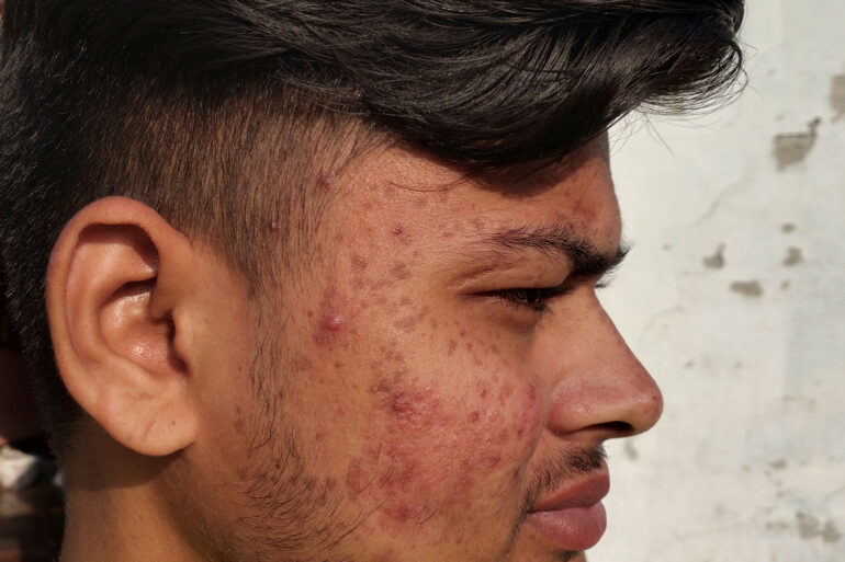 Flat warts for 7 years and Acne Vulgaris got cured in a patient from Ghaziabad