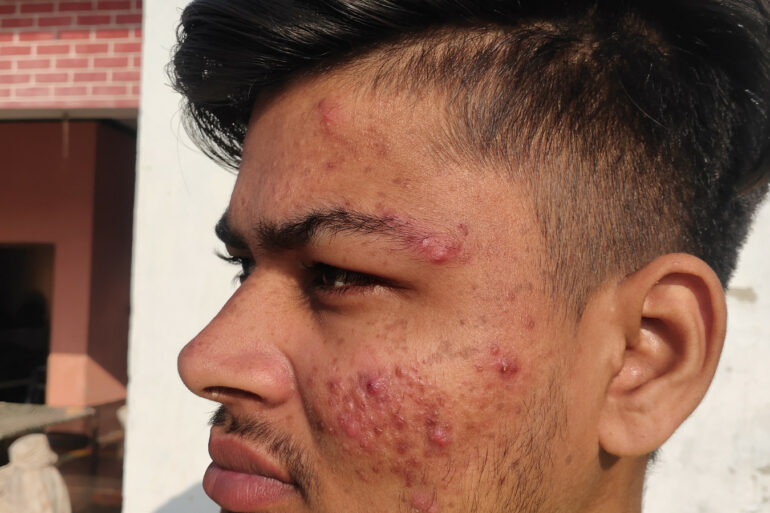 Flat warts for 7 years and Acne Vulgaris got cured in a patient from Ghaziabad