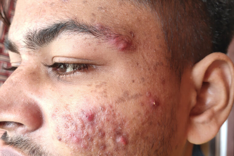 Flat warts for 7 years and Acne Vulgaris got cured in a patient from Ghaziabad