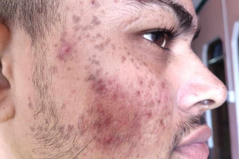 Flat warts for 7 years and Acne Vulgaris got cured in a patient from Ghaziabad