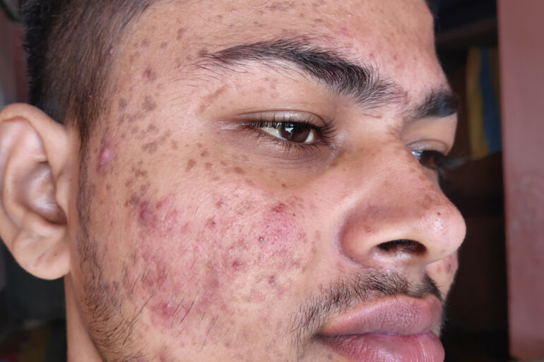 Flat warts for 7 years and Acne Vulgaris got cured in a patient from Ghaziabad