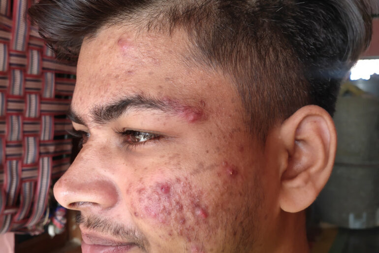 Flat warts for 7 years and Acne Vulgaris got cured in a patient from Ghaziabad