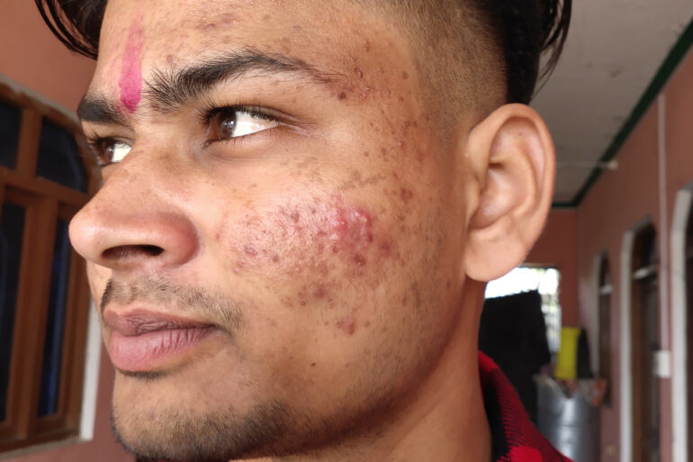 Flat warts for 7 years and Acne Vulgaris got cured in a patient from Ghaziabad