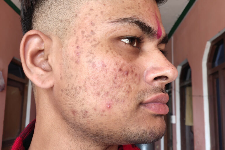 Flat warts for 7 years and Acne Vulgaris got cured in a patient from Ghaziabad