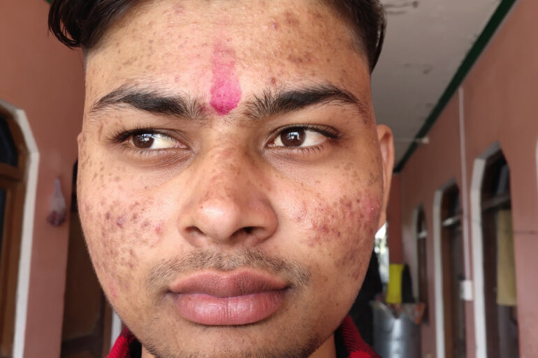 Flat warts for 7 years and Acne Vulgaris got cured in a patient from Ghaziabad