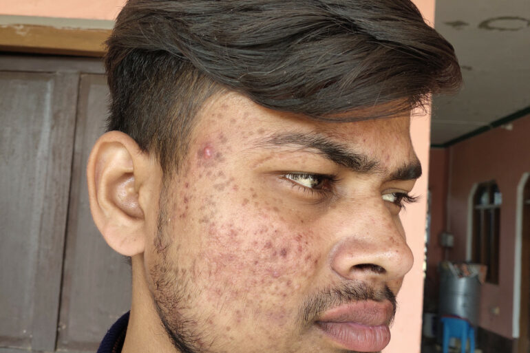 Flat warts for 7 years and Acne Vulgaris got cured in a patient from Ghaziabad