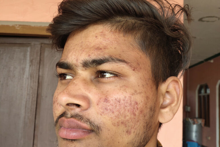 Flat warts for 7 years and Acne Vulgaris got cured in a patient from Ghaziabad