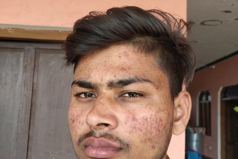 Flat warts for 7 years and Acne Vulgaris got cured in a patient from Ghaziabad