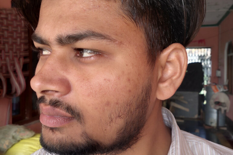 Flat warts for 7 years and Acne Vulgaris got cured in a patient from Ghaziabad