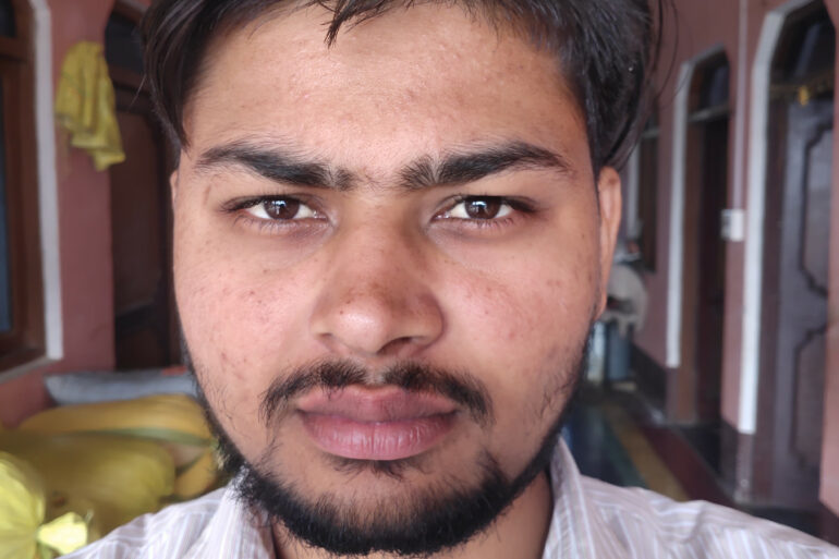 Flat warts for 7 years and Acne Vulgaris got cured in a patient from Ghaziabad