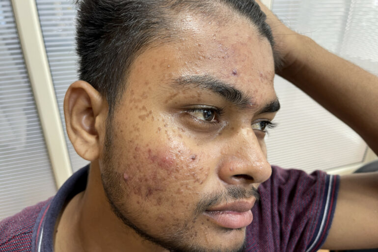 Flat warts for 7 years and Acne Vulgaris got cured in a patient from Ghaziabad