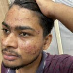 Flat warts for 7 years and Acne Vulgaris got cured in a patient from Ghaziabad