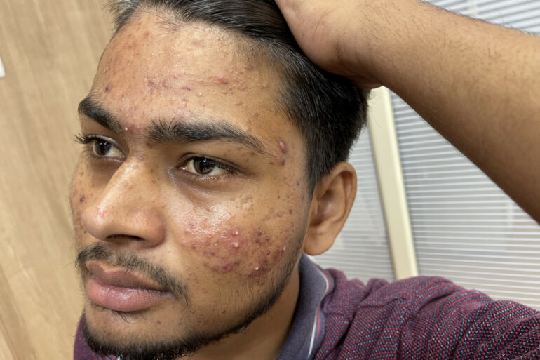 Flat warts for 7 years and Acne Vulgaris got cured in a patient from Ghaziabad