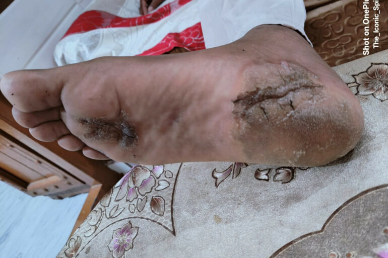 A case of Planter Psoriasis