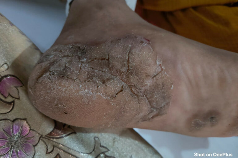 A case of Planter Psoriasis