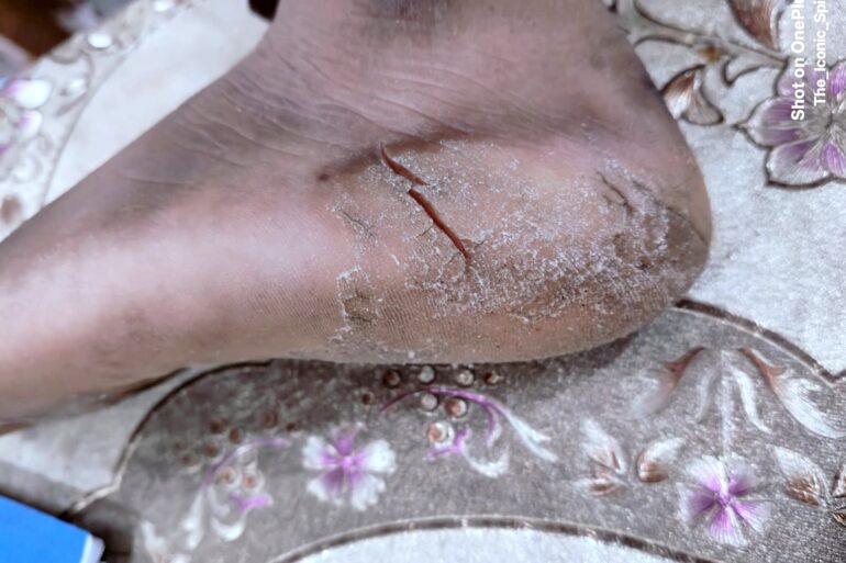 A case of Planter Psoriasis