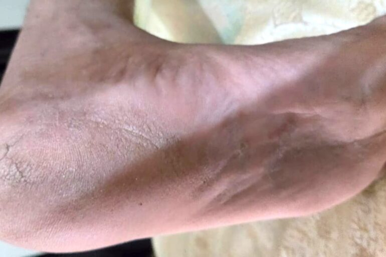 A case of Planter Psoriasis