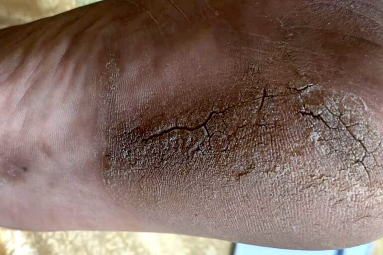 A case of Planter Psoriasis