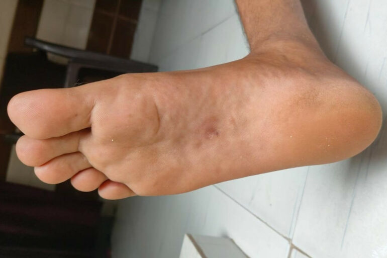 A case of Planter Psoriasis