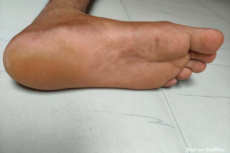 A case of Planter Psoriasis