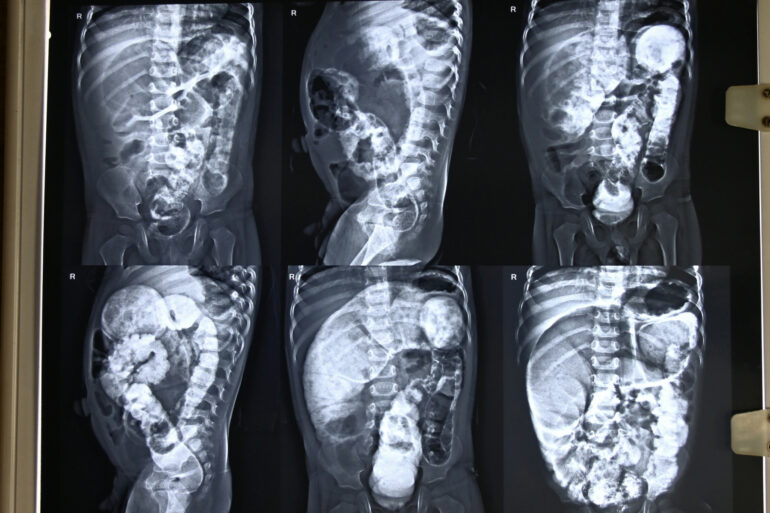 A ray of Hope in a case of Hirschsprung’s Disease. Case from Kanpur getting cured