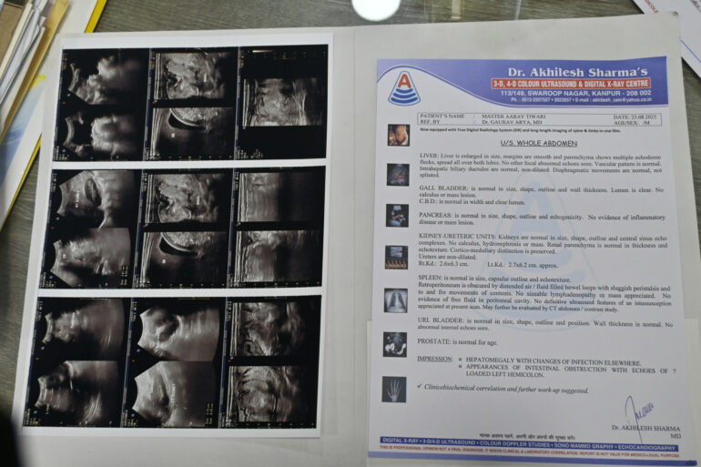 A ray of Hope in a case of Hirschsprung’s Disease. Case from Kanpur getting cured