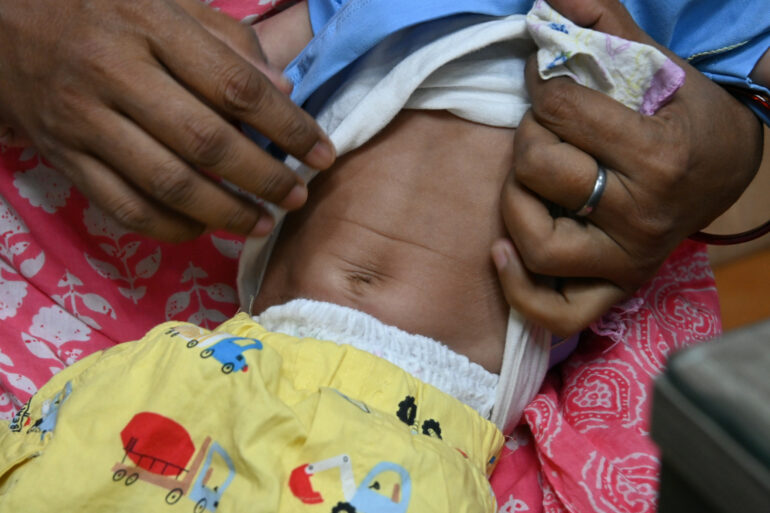 Recovery from Hirschsprung’s Disease without Surgery – A case from Lucknow