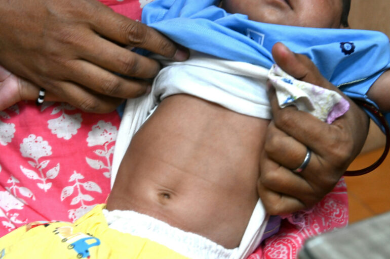 Recovery from Hirschsprung’s Disease without Surgery – A case from Lucknow