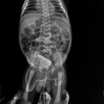 Recovery from Hirschsprung’s Disease without Surgery – A case from Lucknow