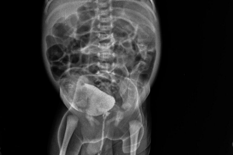 Recovery from Hirschsprung’s Disease without Surgery – A case from Lucknow