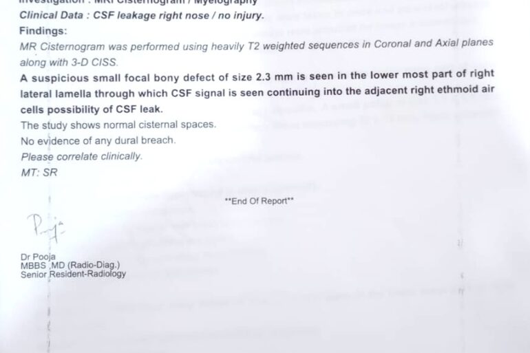 A well diagnose case of CSF Rhinorrhea getting cured. MR cisternography revealed 2.3 mm bony defect.