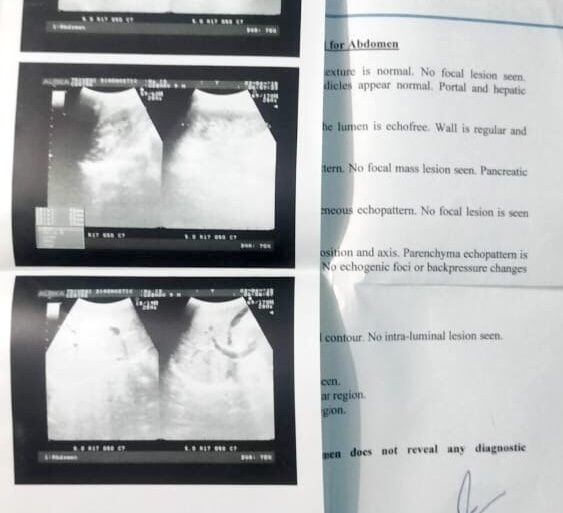 Case of Inguinal Hernia Got Cured