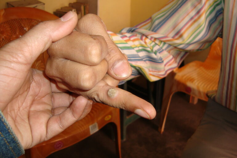 A case of Filiform wart