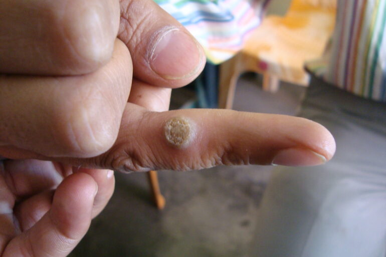 A case of Filiform wart