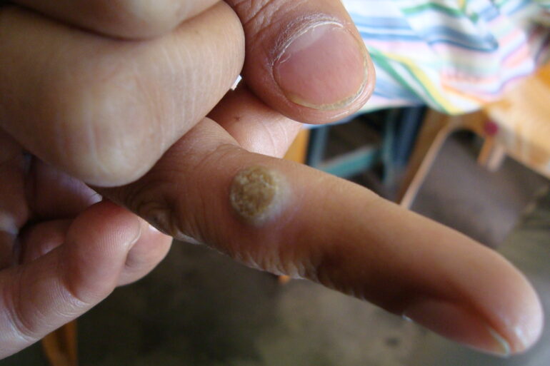 A case of Filiform wart