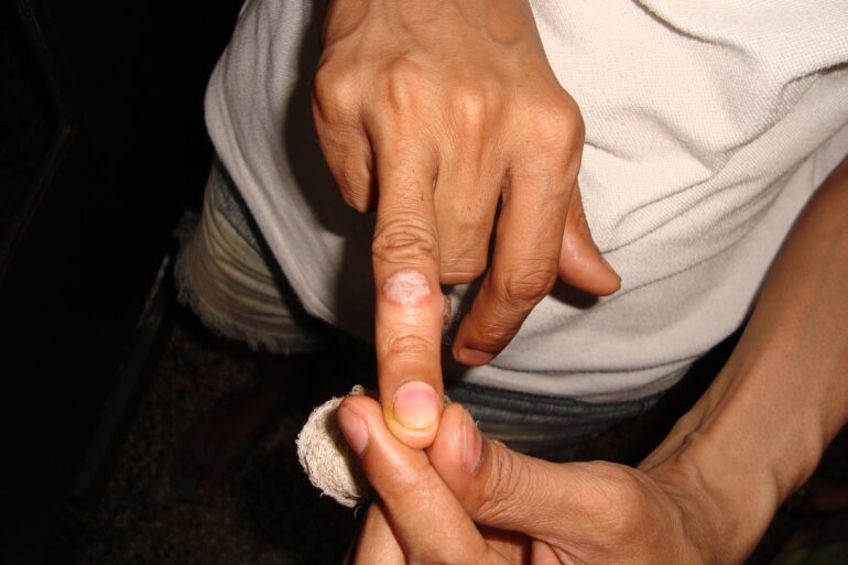 A case of Filiform wart