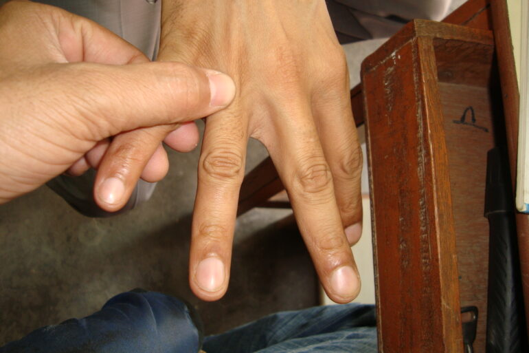 A case of Filiform wart