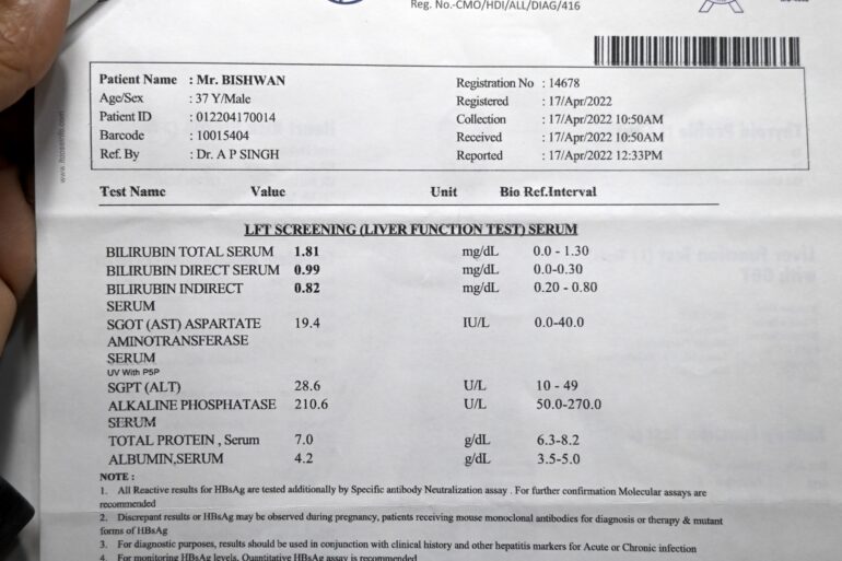 Chyluria Milky Urine – Relief from Day 1