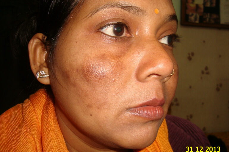 Cure of Long Term Chloasma and Migraine With Homeopathy