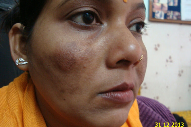 Cure of Long Term Chloasma and Migraine With Homeopathy